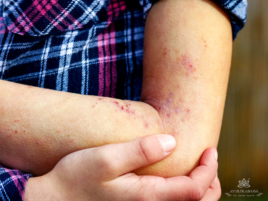 HOW TO CHOOSE THE BEST BODY CREAM FOR ECZEMA